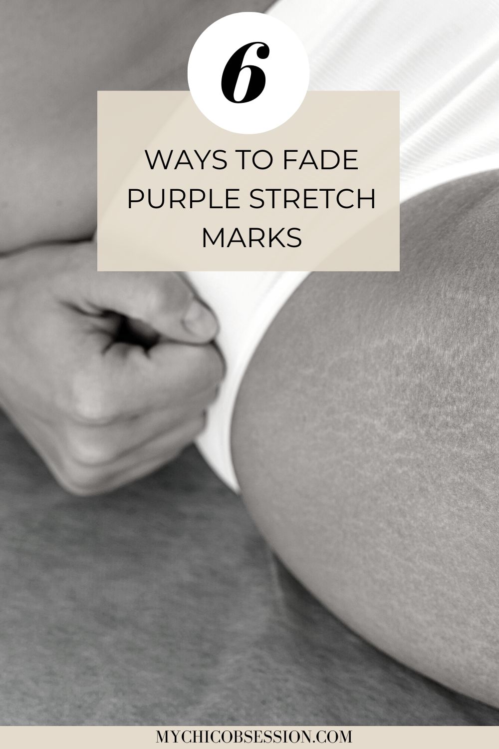 how to fade purple stretch marks